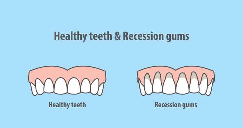 Healthy-teeth-and-recession-gums infographic