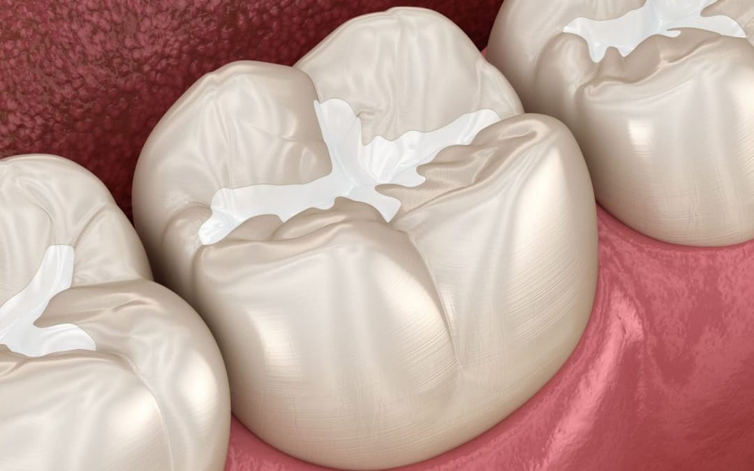 Should my child get dental sealants?