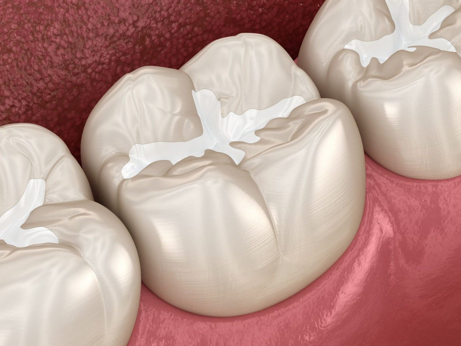 Should my child get dental sealants?