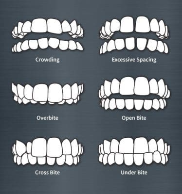 Illustration-of-teeth-types-that-are-candidates-for-Invisalign-treatment