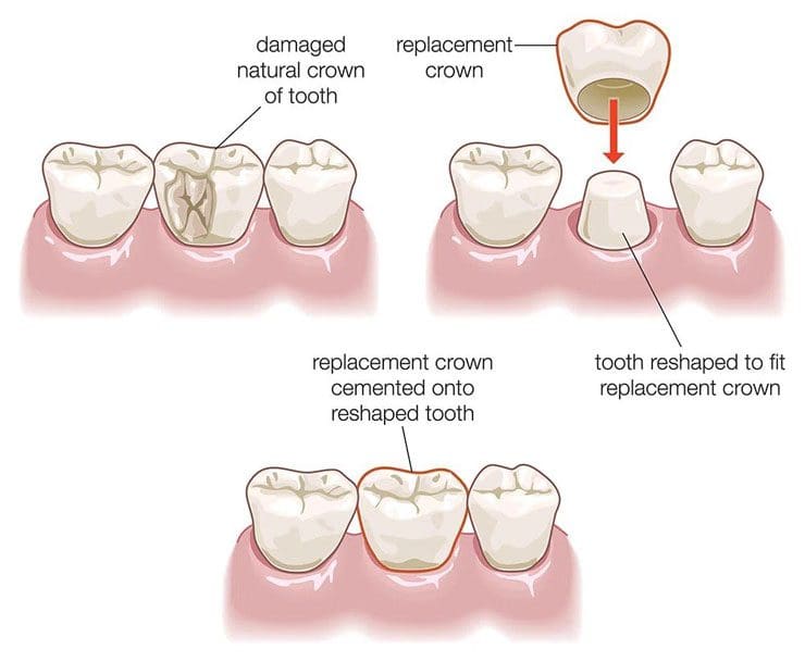 Parkview Dental Crown Image