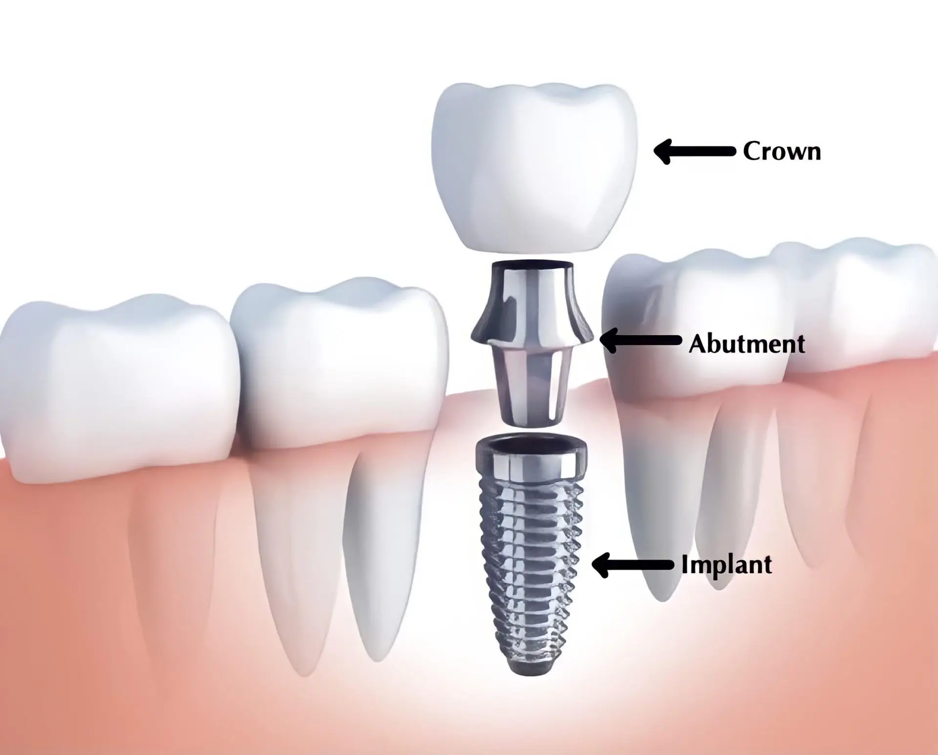 dental-inplant-illustration
