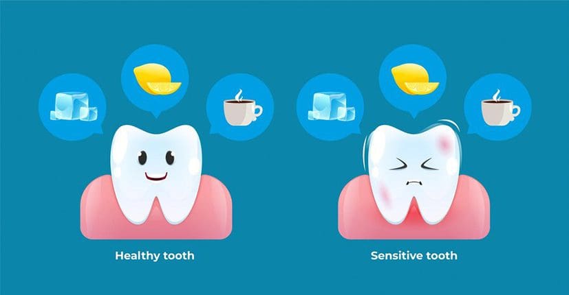 Teeth Hypersensitivity – At-home and In-office Treatment