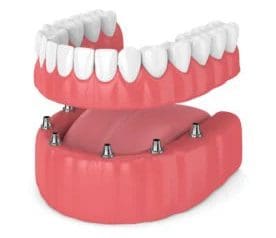 implant-dentures