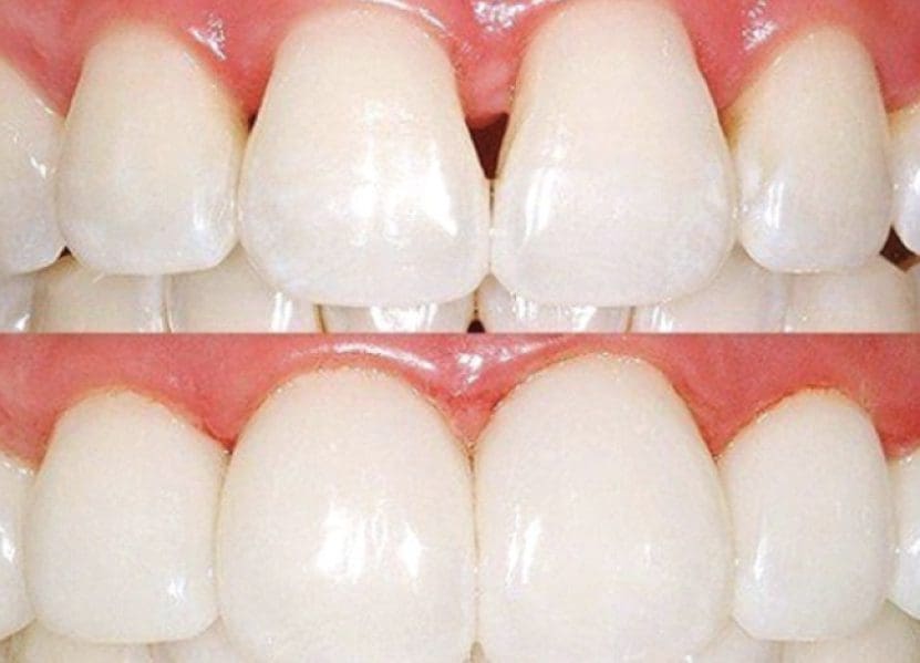 before and after comparison of a person's teeth