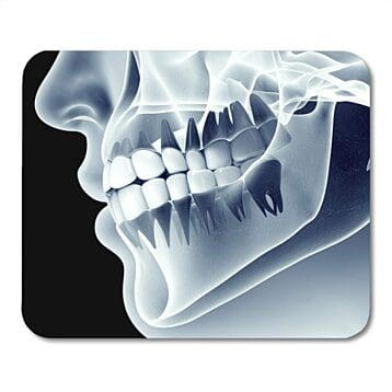 Why do I need dental radiographs (X-rays) every year?